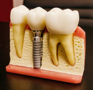 Dental Implant