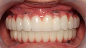 Implant Overdenture