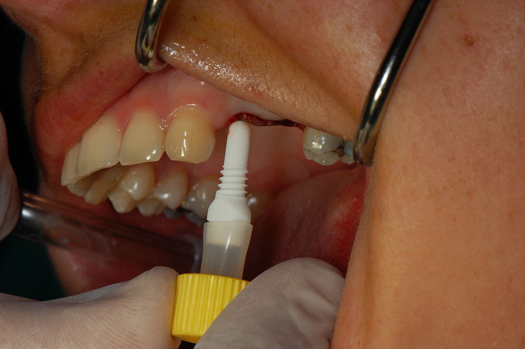 CeraRoot Ceramic Implant CeraRoot Ceramic Implant
