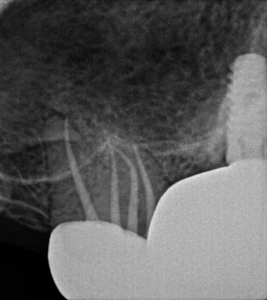 Maxillary Molar Root Canal