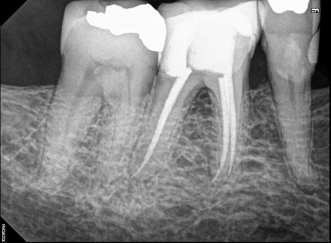 Lower Molar Root Canal