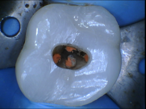 Ninja Access Root Canal