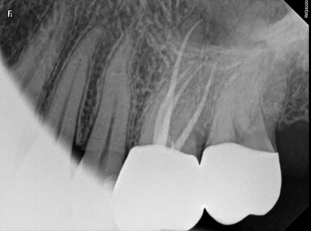 Root Canal Tooth #14