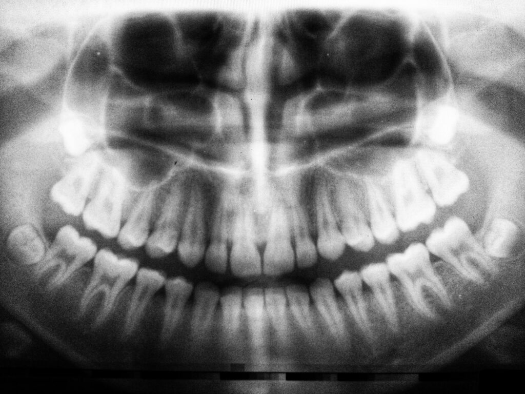 Dental X-ray showing impacted wisdom teeth.
