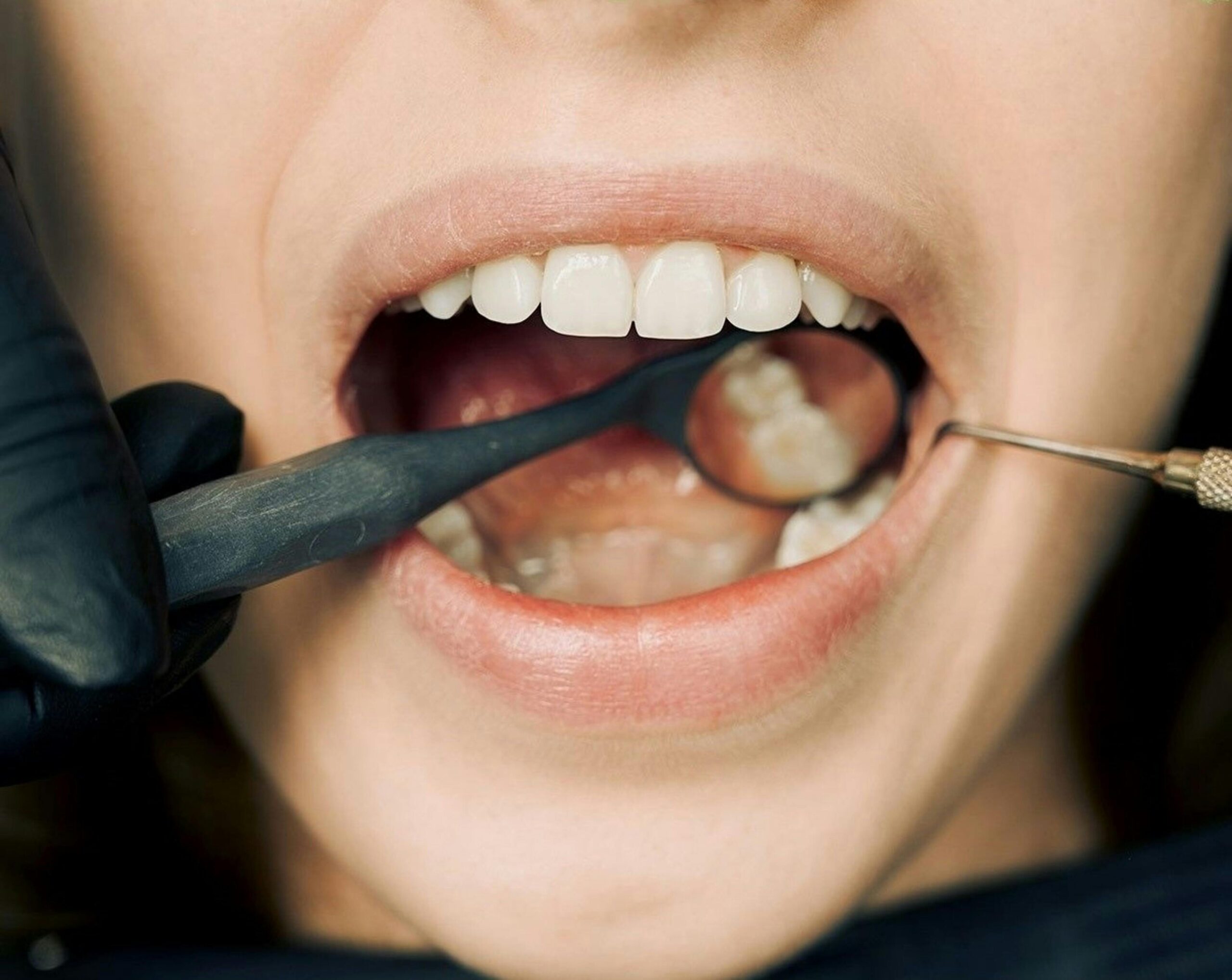 Close-up of a dental examination with tools in a patient's mouth.