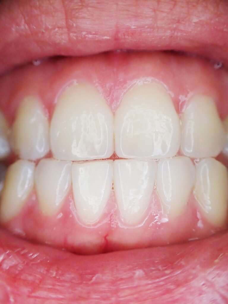 Close-up of clean teeth and gums.