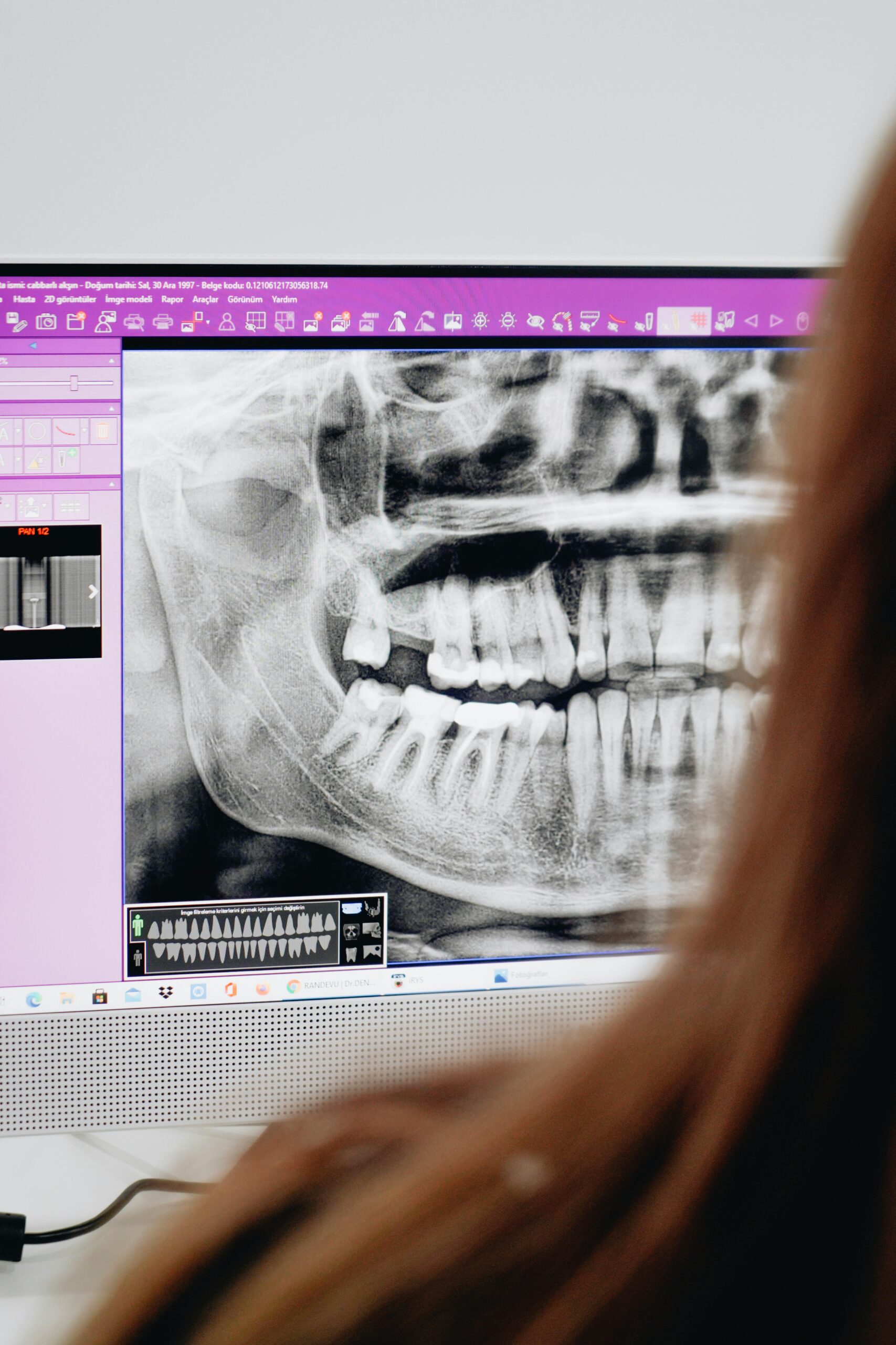 Dental X-ray displayed on a computer screen.