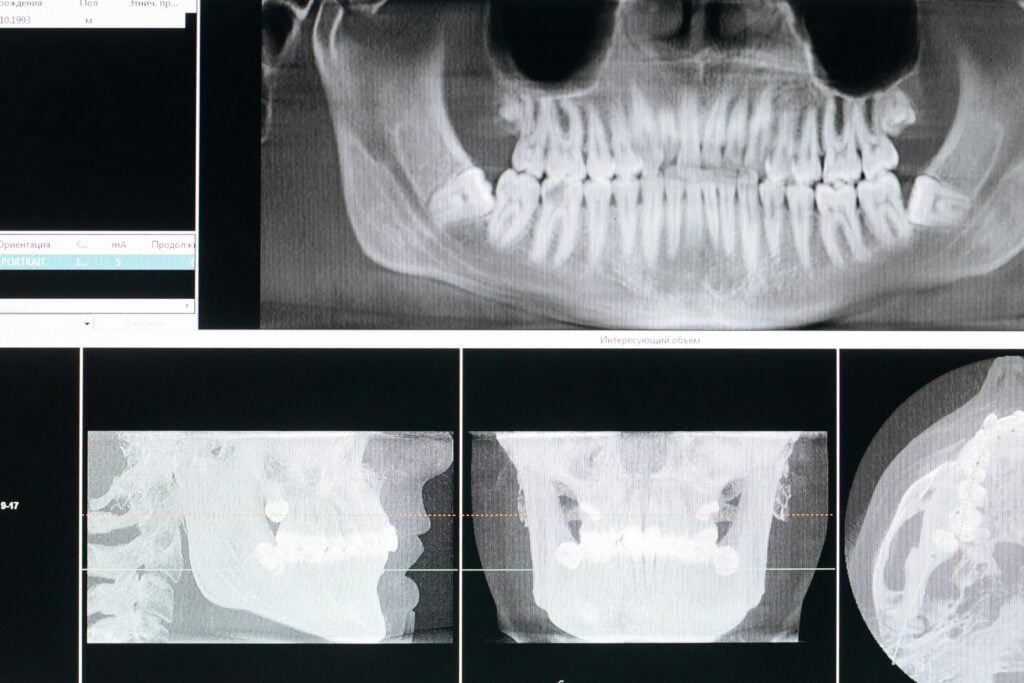 Dental CBCT scan images showing detailed views of teeth and jaw.