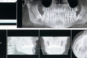 Dental CBCT scan images showing detailed views of teeth and jaw.